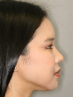 Nonsurgical Rhinoplasty (Nose Reshaping)