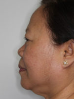 Nonsurgical Rhinoplasty (Nose Reshaping)