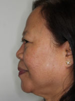 Nonsurgical Rhinoplasty (Nose Reshaping)