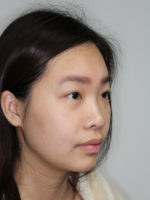 Nonsurgical Rhinoplasty (Nose Reshaping)