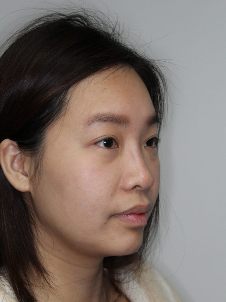 Nonsurgical Rhinoplasty (Nose Reshaping)