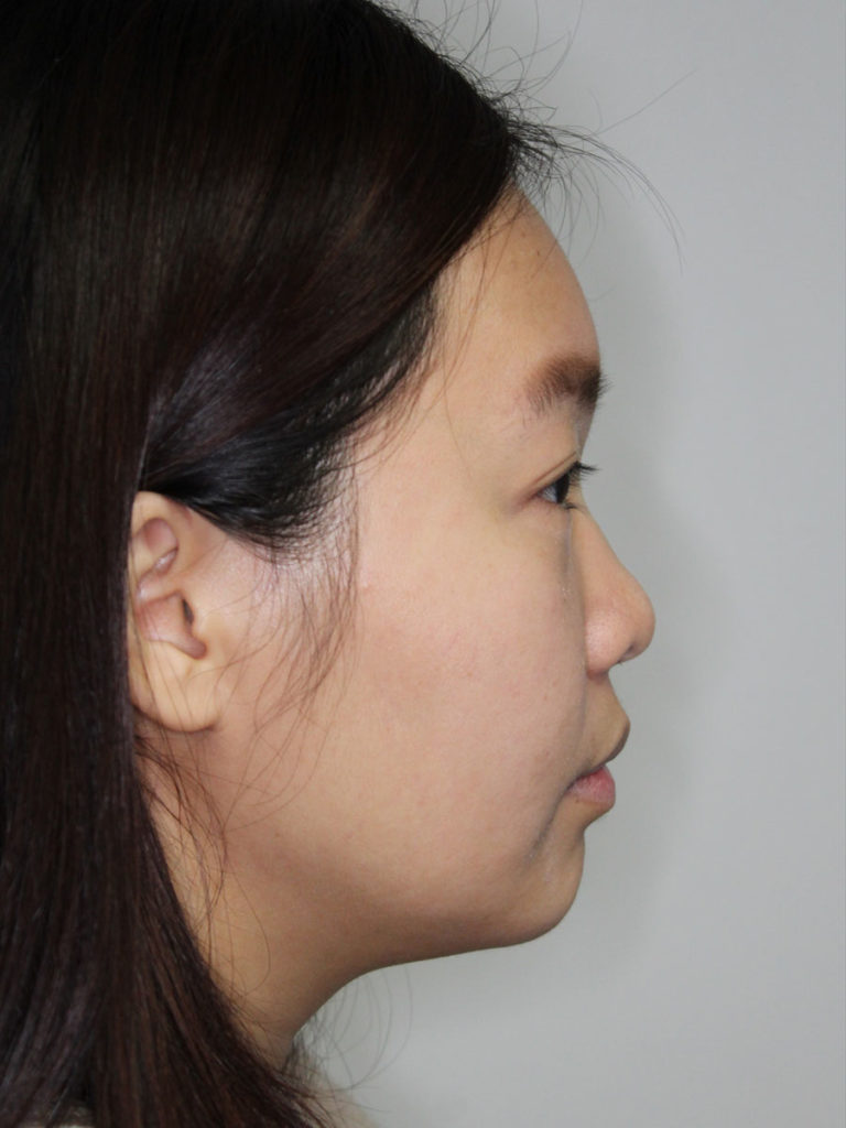 Nonsurgical Rhinoplasty (Nose Reshaping)