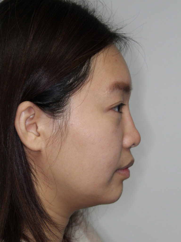 Nonsurgical Rhinoplasty (Nose Reshaping)