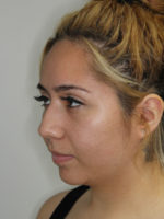 Nonsurgical Rhinoplasty (Nose Reshaping)