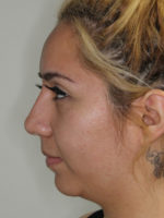 Nonsurgical Rhinoplasty (Nose Reshaping)