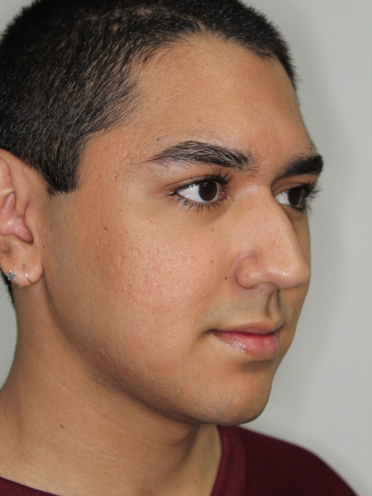 Nonsurgical Rhinoplasty (Nose Reshaping)