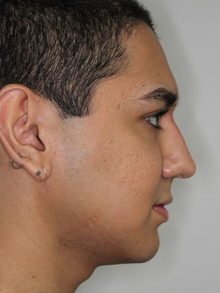 Nonsurgical Rhinoplasty (Nose Reshaping)