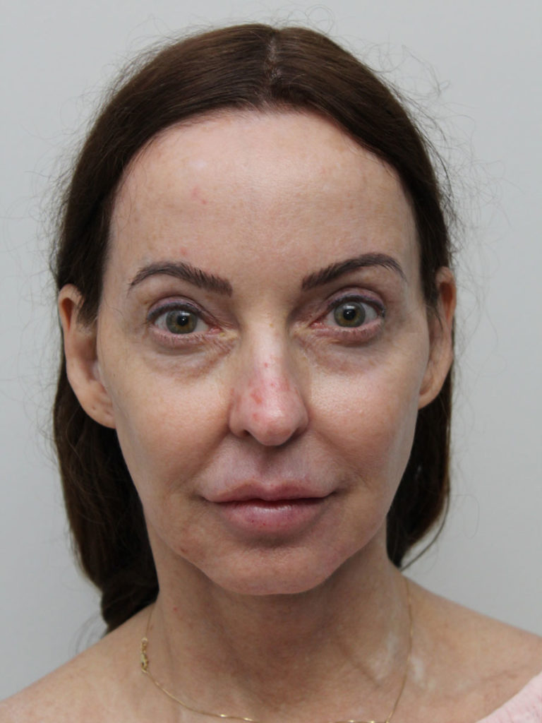 Facelift/Necklift