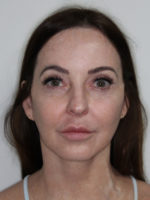 Facelift/Necklift