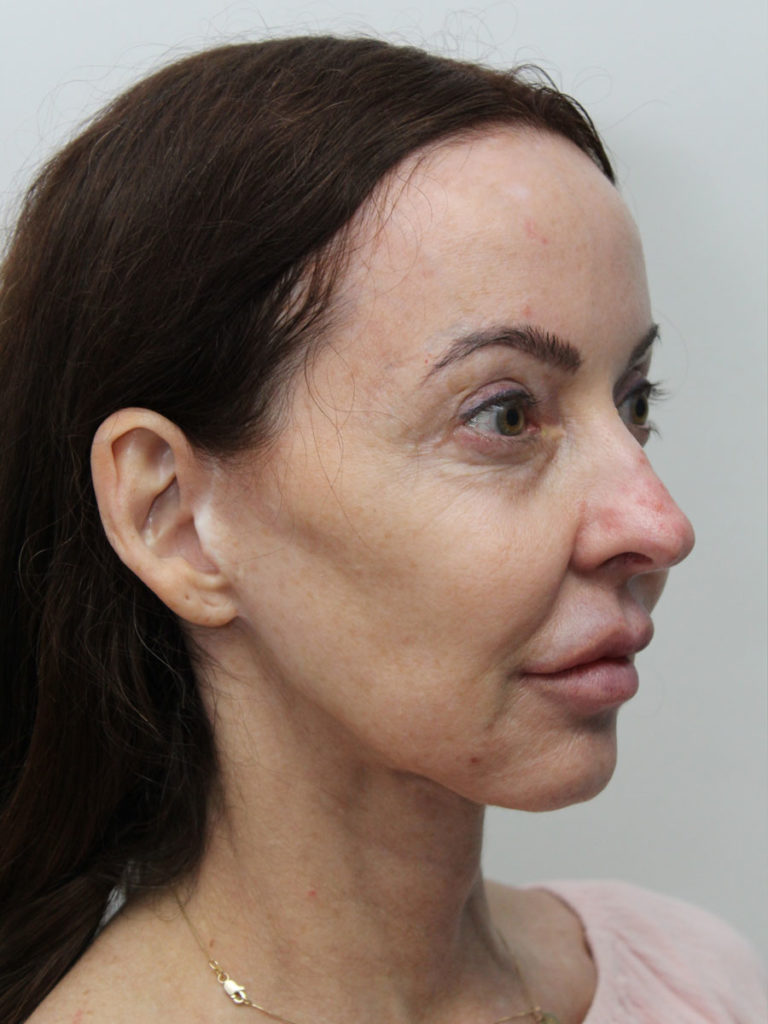 Facelift/Necklift