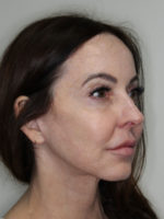 Facelift/Necklift