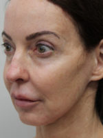 Facelift/Necklift