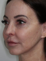 Facelift/Necklift