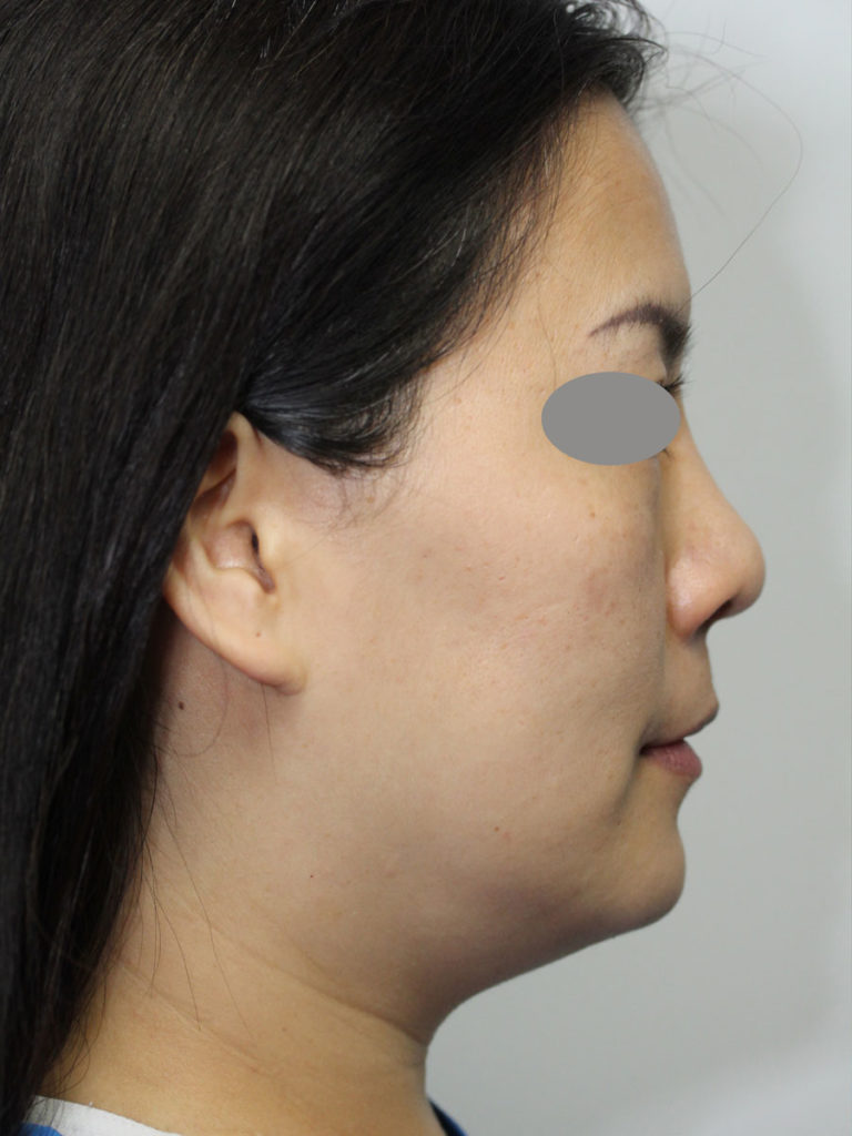 Rhinoplasty (Nose Job)