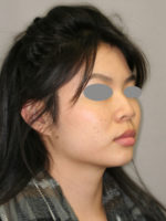 Rhinoplasty (Nose Job)