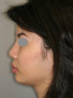 Rhinoplasty (Nose Job)