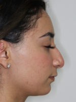 Rhinoplasty (Nose Job)