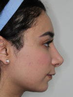 Rhinoplasty (Nose Job)