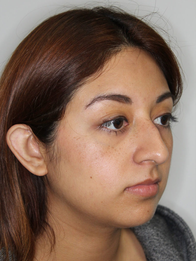 Rhinoplasty (Nose Job)