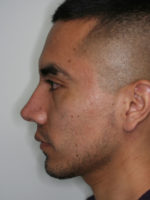 Rhinoplasty (Nose Job)