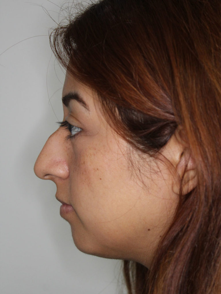 Rhinoplasty (Nose Job)