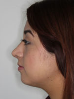 Rhinoplasty (Nose Job)