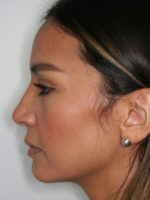 Rhinoplasty (Nose Job)