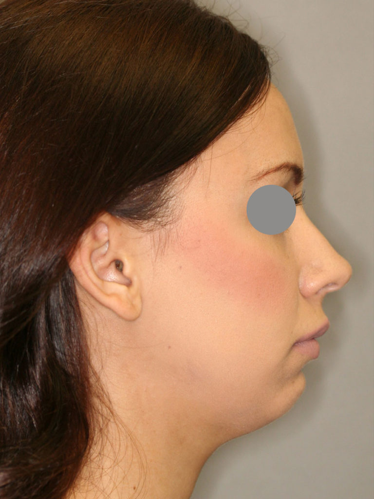 Rhinoplasty (Nose Job)