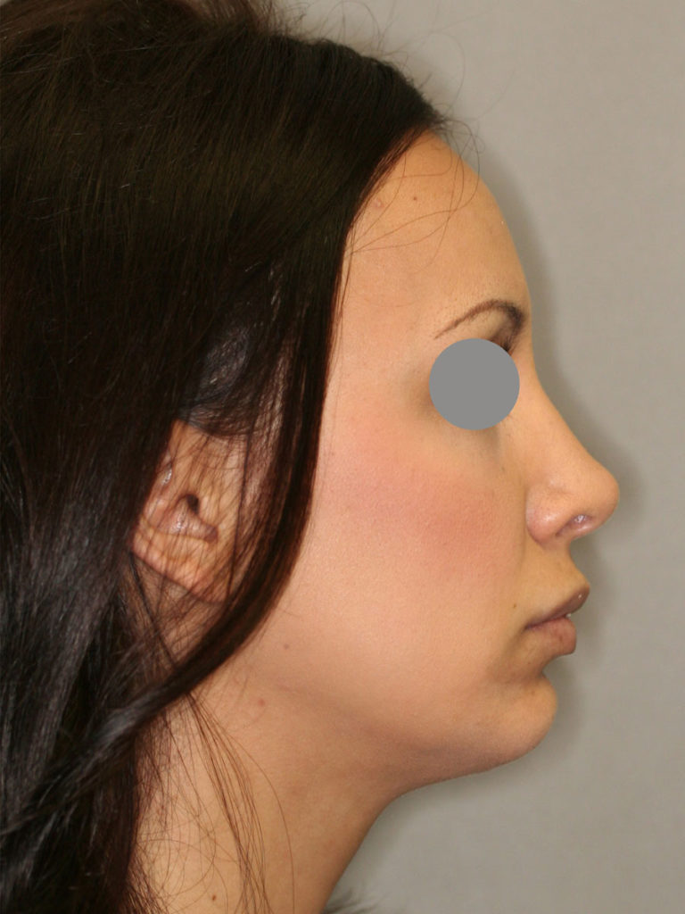 Rhinoplasty (Nose Job)