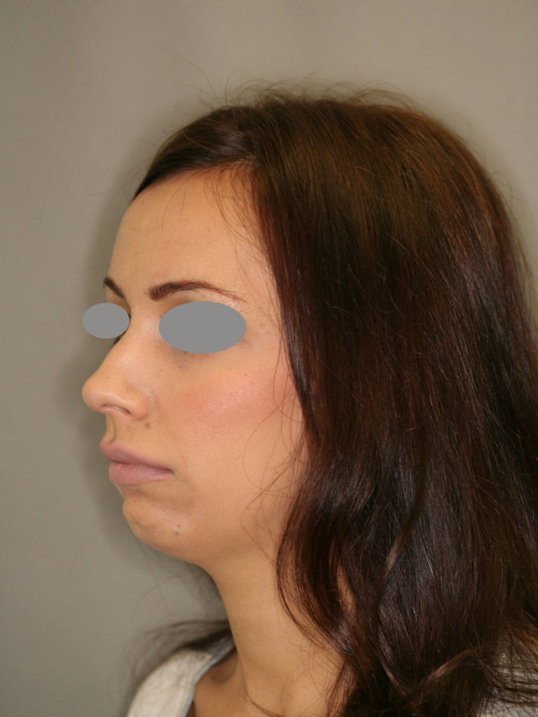 Rhinoplasty (Nose Job)