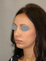 Rhinoplasty (Nose Job)