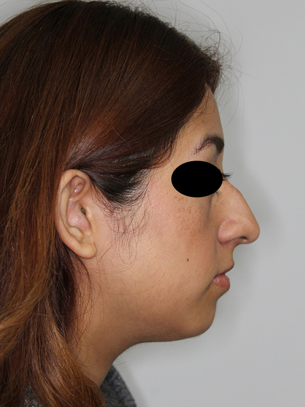 Rhinoplasty (Nose Job)