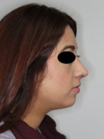 Rhinoplasty (Nose Job)