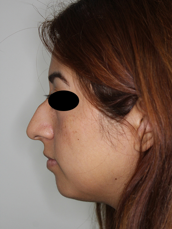 Rhinoplasty (Nose Job)