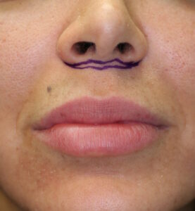 Initial markings for a lip augmentation procedure