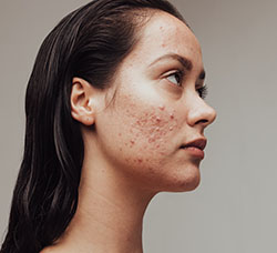 Acne skin
