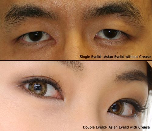 Asian Eyelid Single and Double comparison
