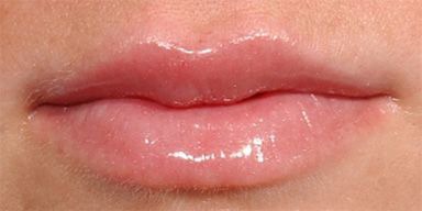Lip Augmentation Before & After