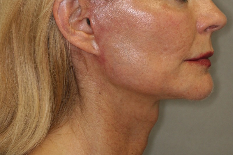 Mini-Facelift Results Pasadena