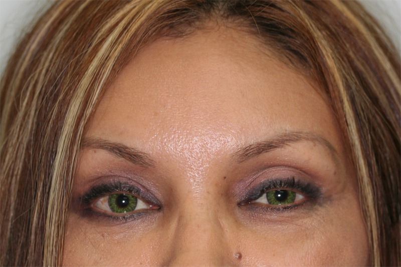 Before & After - Brow Lift