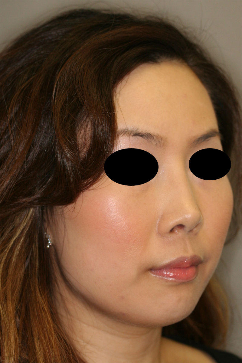 Asian Rhinoplasty Pasadena | Asian Nose Surgery Arcadia