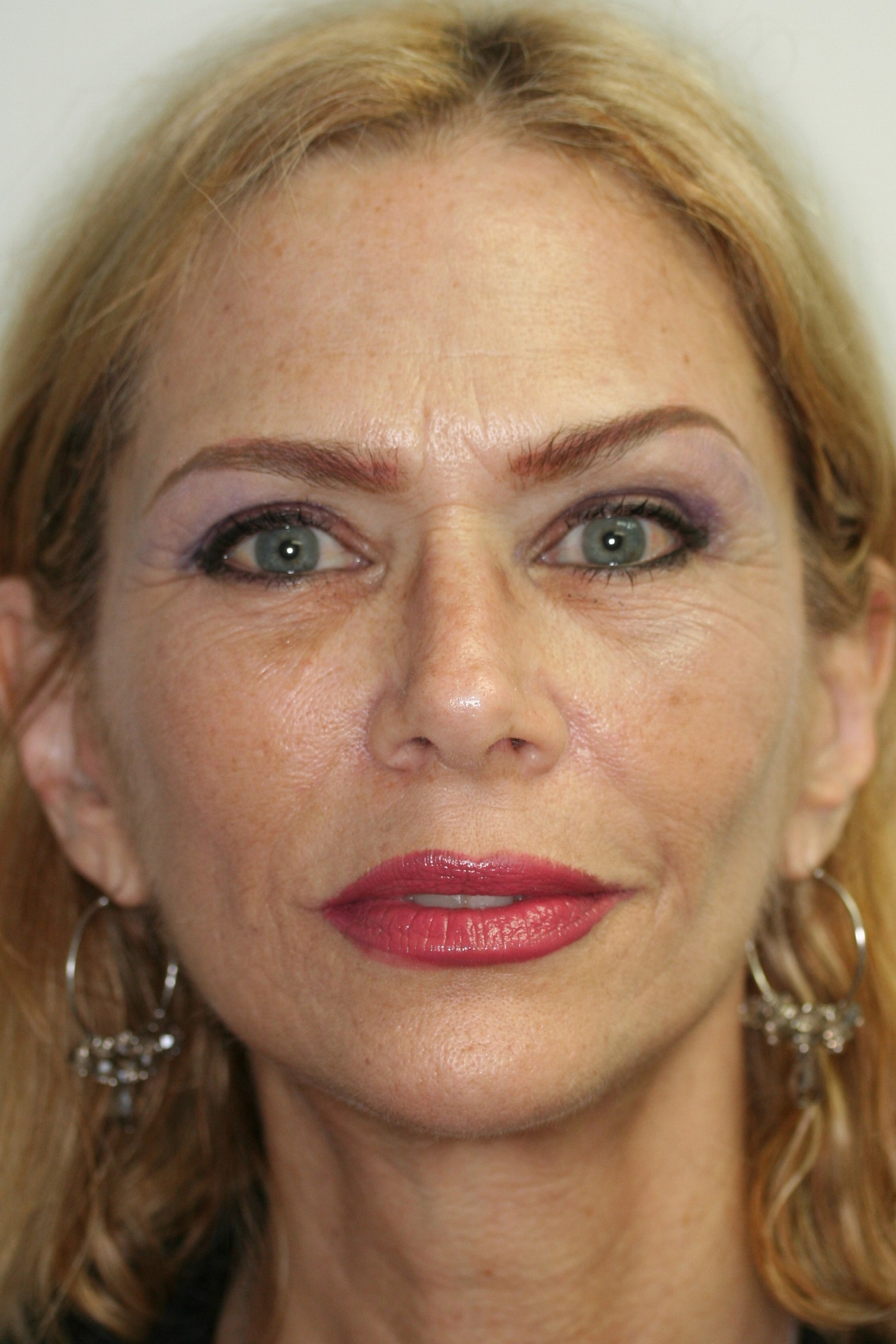 Facelift - Before & After