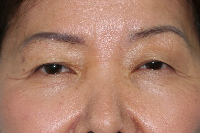 Blepharoplasty Eyelid Surgery Results Arcadia